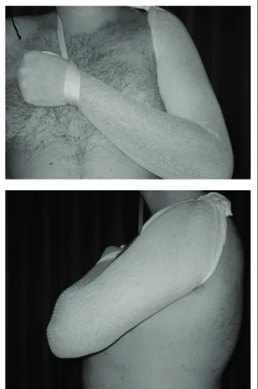 Figure 2. Patient during restriction procedure using tubular mesh.