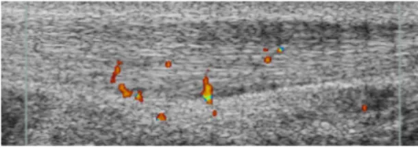 Figure 1. Ultrasound and Doppler examination showing a thickened  Achilles tendon mid portion with irregular structure and high blood  low outside and inside the ventral side of the Achilles tendon.