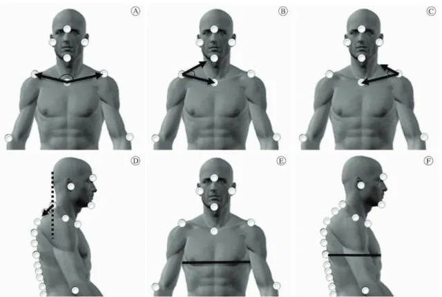 Figure 2. Representation of measures for evaluation of thoracic alterations; elevation of clavicles (2A); elevation of right and left shoulder  (2B and 2C); protrusion of head (2D); mediolateral thoracic distance (2E); anteroposterior thoracic distance (2F