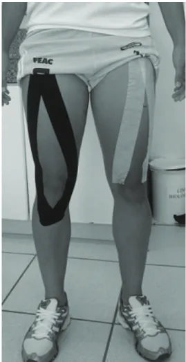 Figure 2. Application of Kinesio Tape (right lower limb) and 3M  Micropore   (left lower limb).