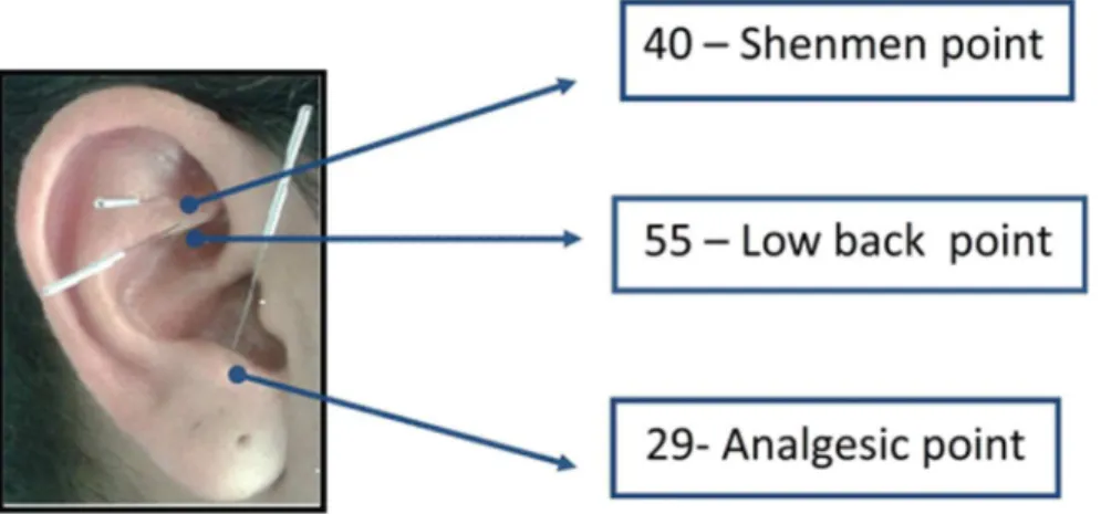 Figure 1. Points in the ear where needles were applied to reduce low back pain 4,25 .