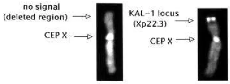 Figura 2.  Hybridization of LSI-Kallmann/CEPX probes on human metaphase chro- chro-mosomes