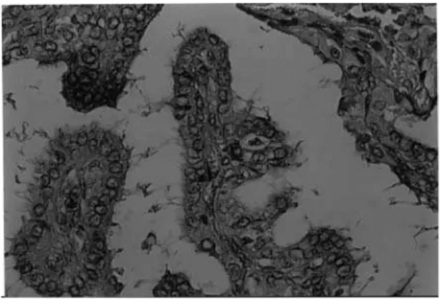 Figure 1. Thyroid 131 I-scintigram shows a “hot” nodule in the right lobe and decreased 131 I-uptake in the left lobe.