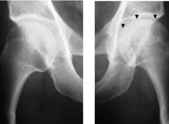 Figure  1. Pelvic  X-ray:  Irregularity  of  the  left  femoral  head