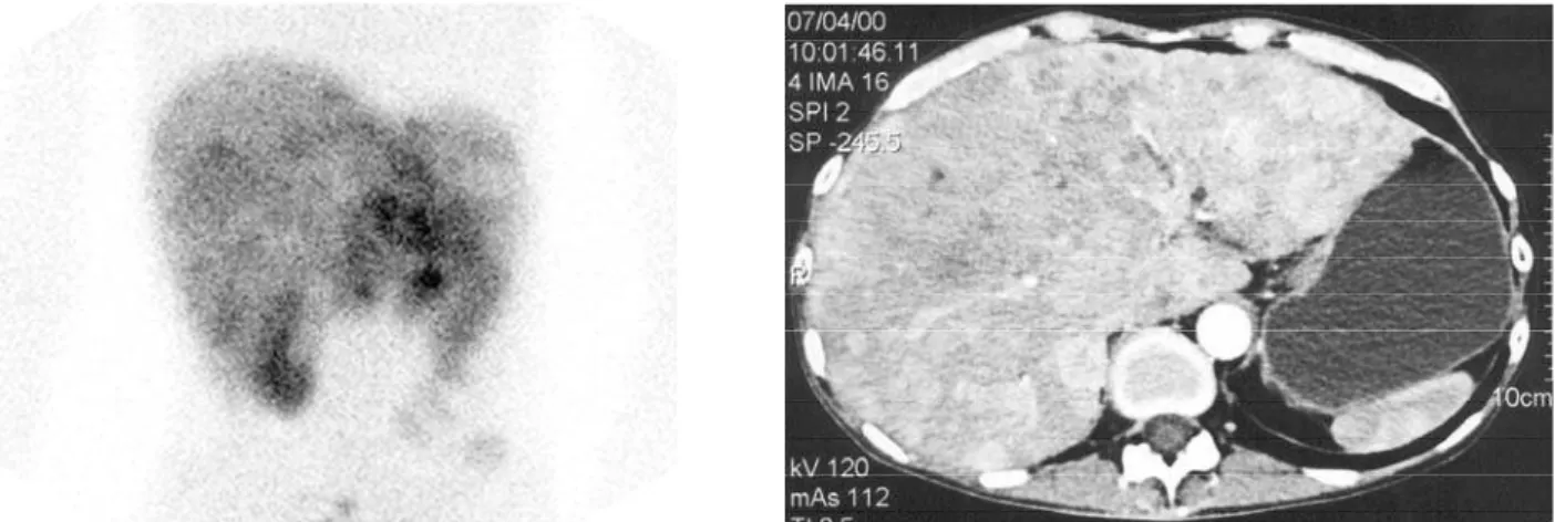 Figure 1. Planar 111 In-pentetreotide scintigraphy (left) and transverse abdominal CT (right) images showing extensive somatostatin receptor-positive liver metastases in a patient with a metastatic midgut carcinoid and the carcinoid syndrome.