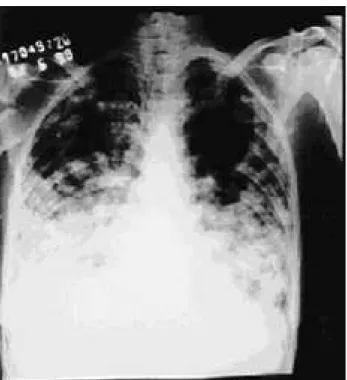 Figure 1. Chest radiography with multiple well circumscribed nodular alterations.
