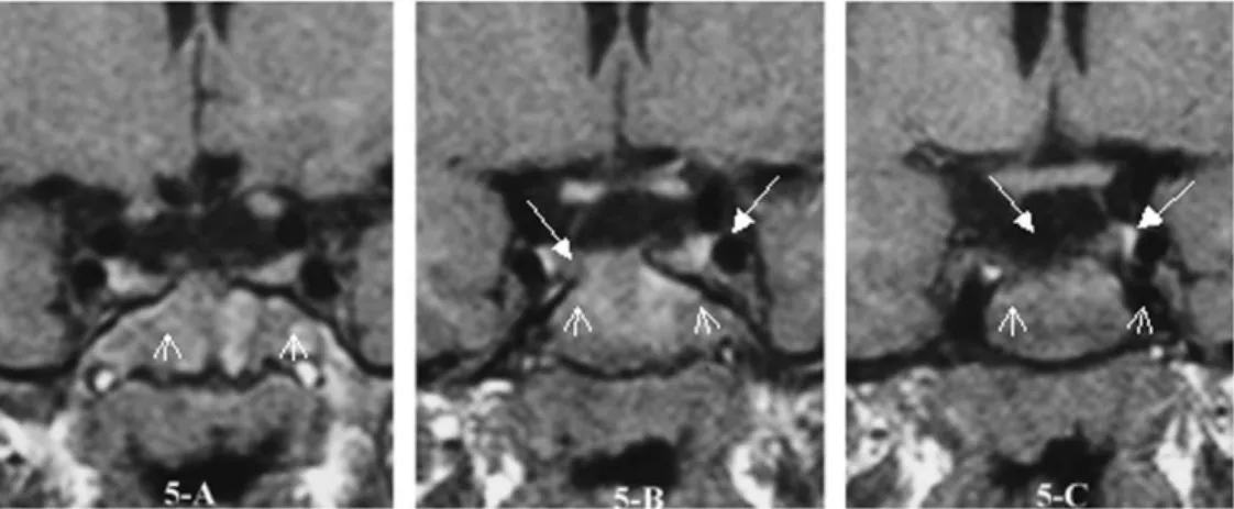 Figure 5. Coronal T1 weighted sections showing pituitary (arrow-heads) and infundibulum (arrows) duplication.
