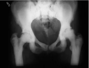 Figure 2. X-ray of pelvis in a patient with osteopetrosis. Note the increased radiodensity of bone and disordered  microar-chitecture of cortical and cancellous bone.