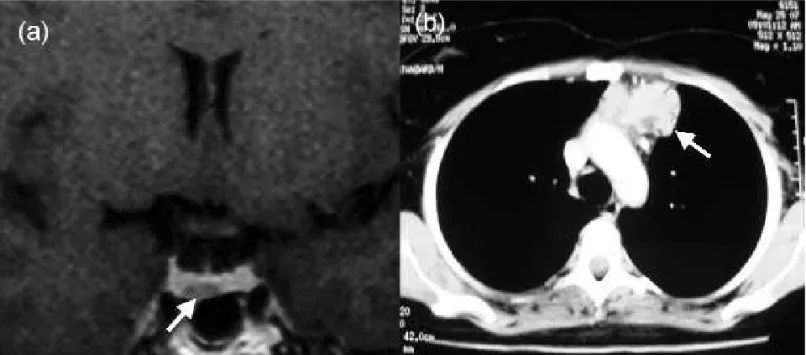 Figure 1. Concomitance of a 6-mm non-functioning pituitary adenoma (a) and a 5.6-cm ACTH secreting thymic carcinoid tumor (b) in a female patient with an ACTH-dependent Cushing’s syndrome