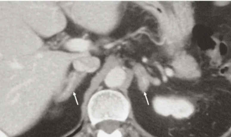 Figure 1. ACTH-dependent smooth hyperplasia of the adre- adre-nals. Post-contrast CT of the adrenal glands acquired 60  sec-onds after intravenous contrast administration from a patient with Cushing’s syndrome