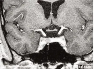 Figure 2. ACTH-dependent macronodular hyperplasia of the adrenals. Post-contrast CT of the adrenal glands acquired 60 seconds after intravenous contrast administration from a patient with Cushing’s disease