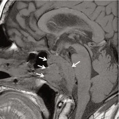Figure 4. MRI of pituitary macroadenoma. Coronal T1- T1-weighted post gadolinium enhanced MR of a pituitary macroadenoma