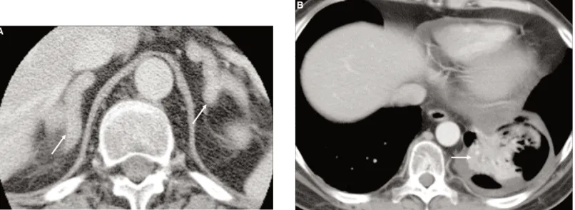 Figure 6. Ectopic ACTH-dependent macronodular hyperplasia of the adrenals. A) Post-contrast CT of the adrenal glands acquired 60 seconds after intravenous contrast administration from a patient with ACTH-dependent Cushing’s syndrome with ectopic ACTH produ