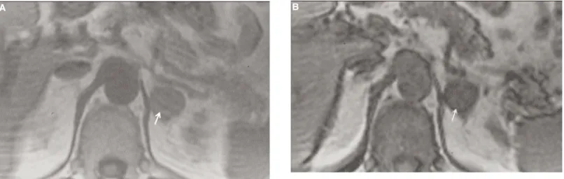 Figure 7. Adrenal adenoma CT. Post-contrast CT of the adrenal glands acquired 60 seconds after intravenous contrast administration showing a left adrenal adenoma (arrow head) in a patient with Cushing’s syndrome