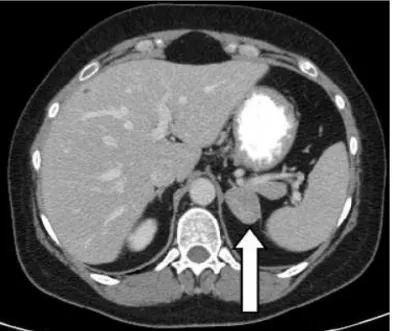 Figure 1. Abdominal CT scan from a 36-year-old woman that presented with hypertension, 14 kg weight gain, easy  bruis-ing, proximal muscle weakness, and poor wound healing.