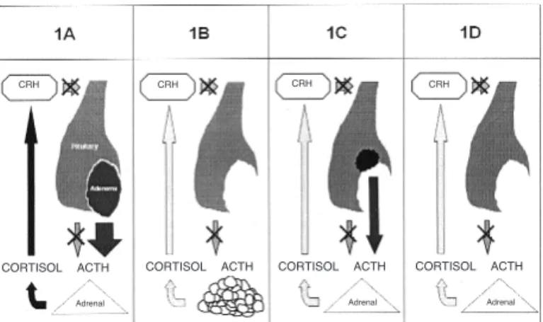 Figure 1. Schematic representation of the pathophysiology of the hypothalamic–pituitary–adrenal axis in patients with Cushing’s disease: pre-treatment (1A), in patient with  remis-sion and reduction of cortisol and adrenal hyperplasia (1B), with residual a
