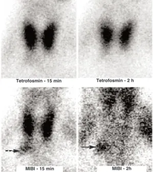 Figure 1. The parathyroid scintigraphy performed with Tc- Tc-99m tetrofosmin (upper row) and Tc-Tc-99m sestamibi (lower row) are presented