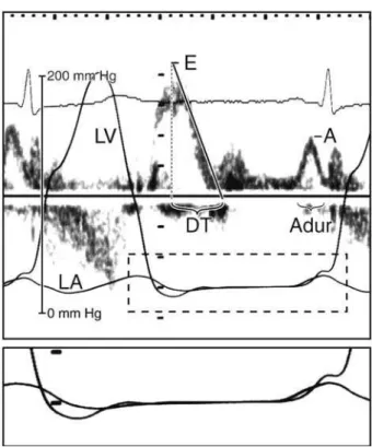 Figure 1. Mitral inflow pattern and left ventricular pressure curves.