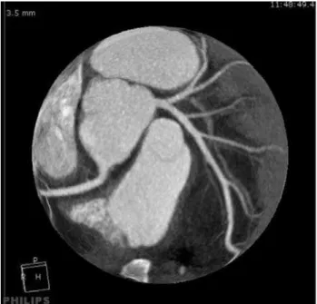 Figure 2. Non-invasive coronary angiogram performed by coronary 64-row multidetector computed tomography.