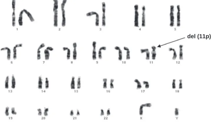 Figure 2.  Karyotype of patient 5.