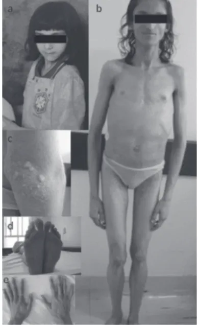 Figure 1.  Photography of the patient at approximately 8 years  of age showing the normal appearance (A) and at current  age showing generalized lipoatrophy, sparse body hair,  protu-berant abdomen, and no breast development (B)