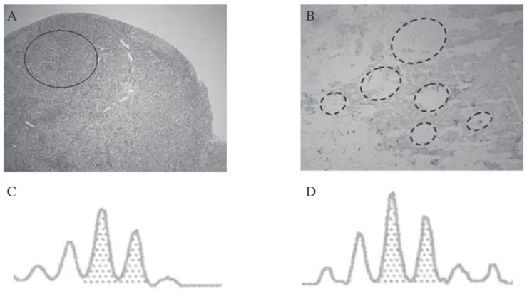 Figure 2.  (A) A transverse section of the adrenal gland indicates a PPNAD nodular area (circle), in which laser-captured micro- micro-dissection was performed