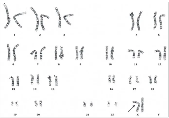 Figure 1.  GTW-banded Karyotype: 46,X,psu idic(X)(pter →  q21::q21 → pter).