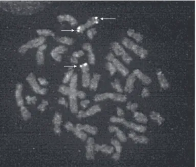 Figure 2. FISH analysis indicating triple copies of SHOX gene in  metaphase chromosome 