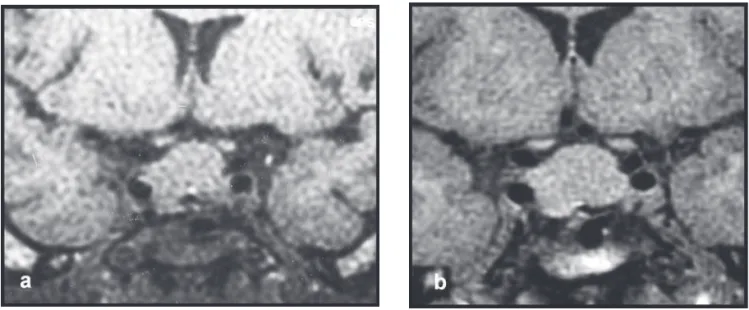 Figure 2.  Sella turcica magnetic resonance, coronal view, T1 weighted, with contrast enhancement, before (A) [tumor volume  3.28 cm 3 ] and 6 months after (B) [tumor volume 3.90 cm 3 ] octreotide LAR ®  treatment.