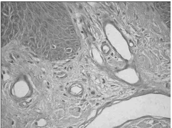 Figure 1. Skin fragment with normal capillaries, classified as 0  or no thickening (AO:400x).