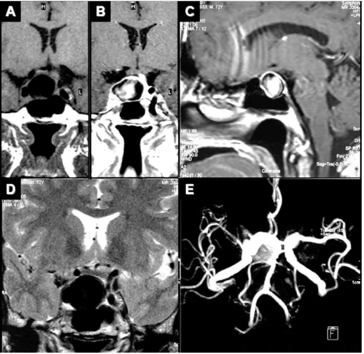 Figure 1. MRI and angioresonance of a 72 years old woman with internal carotid artery aneurysm