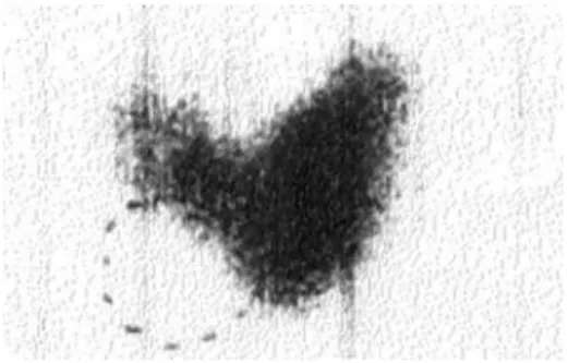Figure 1.  131 I thyroid scintigraphy showing the presence of one 