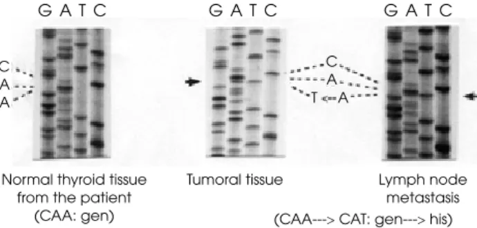 Figure 4. Presence of a point mutation in codon 623 of the  TSH receptor gene (A623S)