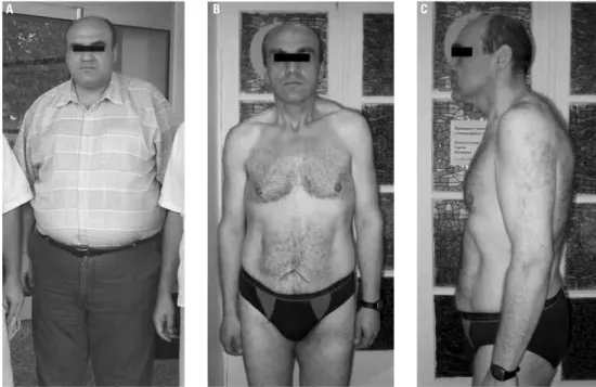 Figure 1. Patient before treatment (A) and after 16 months of treatment (B e C).