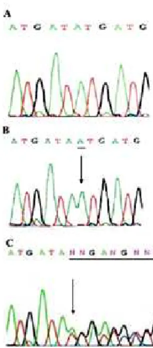 Figure  1. Sequence  analysis  of  exon  2  of  the NR0B1A/DAX1  gene  in  (A)  control  (normal individual); (B) index case: A nucleotide insertion at position 1382, leading a  frameshift  mutation  (ATG  –  AAT)  at  codon  461  (pMet461Asp);  (C)  mothe