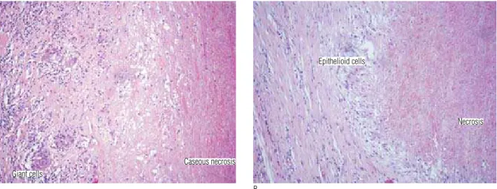 Figure 1. (A) Epithelioid granulomas with central caseous necrosis, epithelioid cells around, some lymphocytes and fibrosis at the periphery; (B) granulomatous inflammation  process with central caseous necrosis, epithelioid and scarce giant cells and a ly