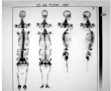 Figure 3. (A) Matrix in PMTMCT. The most of the matrix seen in this PMTMCT is of  smudgy eosinophilic quality, with bland spindled cell in left corner on the top and  osteoid  matrix