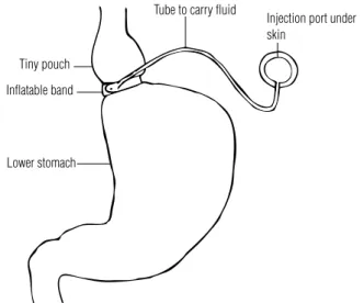 Figure 2. Adjustable gastric banding. A common gastric restrictive operation, limiting  oral intake.