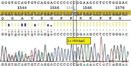 Figure 1. Electropherogram showing the c1561dupC mutation characterized by the insertion of an additional cytosine at position 1561 of the  MEN 1  gene  predicting a truncated form of menin