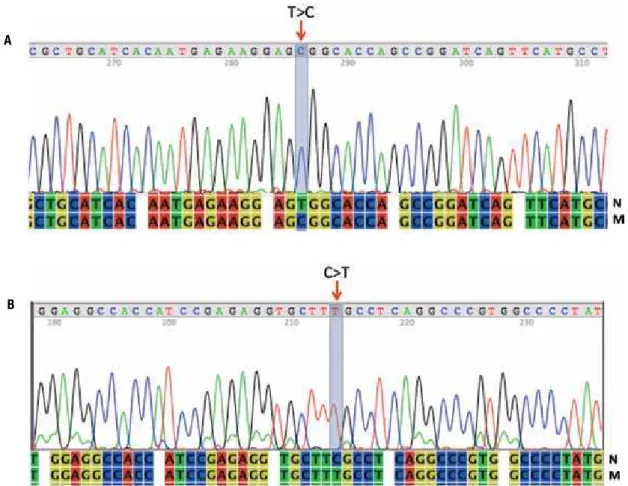 Figure 2. Eletropherograms showing parts of the CYP17A1  gene sequences. A) Exon 7; the arrow denotes the c.1388T>C change causing the p.W406R  mutation found in patients 1, 2.1 and 2.2