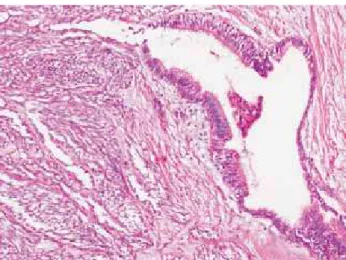 Figure  2.  Biphasic  pattern  composed  of  a  mixture  of  a  predominant  component of spindle cells and a glandular component.