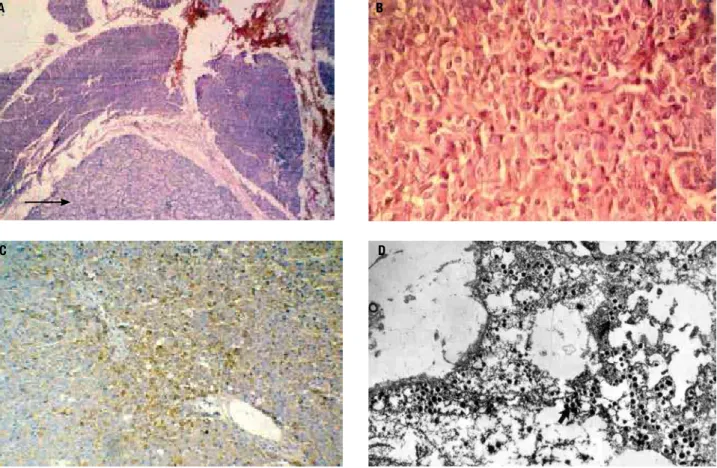 Figure 1. (A) HE-50X: The arrow indicates a hypercellular pancreatic nodule with thin capsule