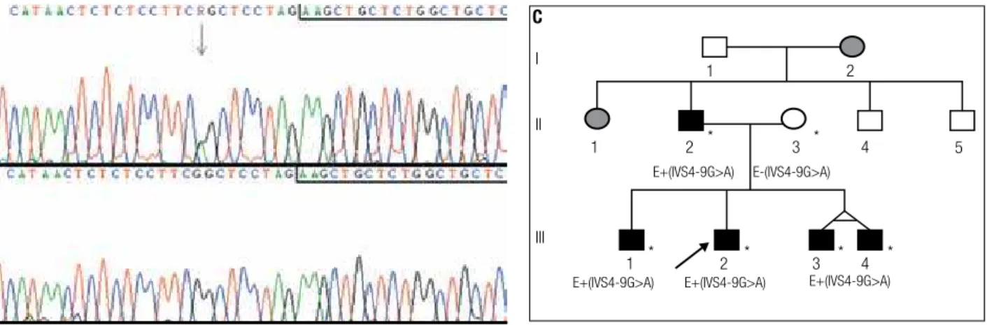 Figure 2. Sequence analysis showing the IVS4-9G>A mutation. Sequences boxed correspond to the first nucleotides of exon 5 and the arrow indicates the  nucleotide change