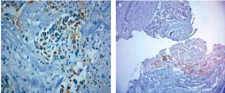 Figure 3. Semiquantitative immunostaining for (a) prolactin (+++/4), (b) KI-67 (++/4), p53-clone DO-7 (+/4) and c-erb B2 (negative)