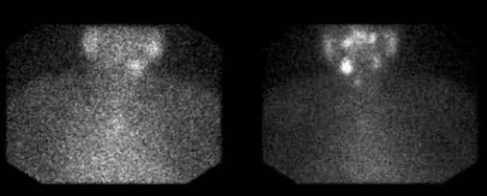 Figure 3. A whole body diagnostic  131 I scintigraphy (5mCi) after stimulation  with recombinant human TSH showing an area of increased uptake at right  submandibular region and thyroid bed.