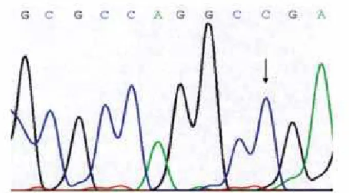 Figure 4. Segment of the chromatograms illustrating a  PROP1  gene allelic  variant in patients 4, 5 and 10, consisting of a biallelic variant (59 A &gt; G,  A20S).