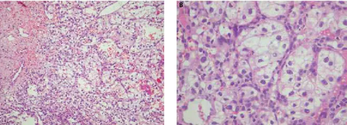 Figure 2. Histological examination of the pituitary tumor: hematoxylin-eosin stain 40x (A) and 100x (B) showing the highly vascular content of renal cell  carcinoma.