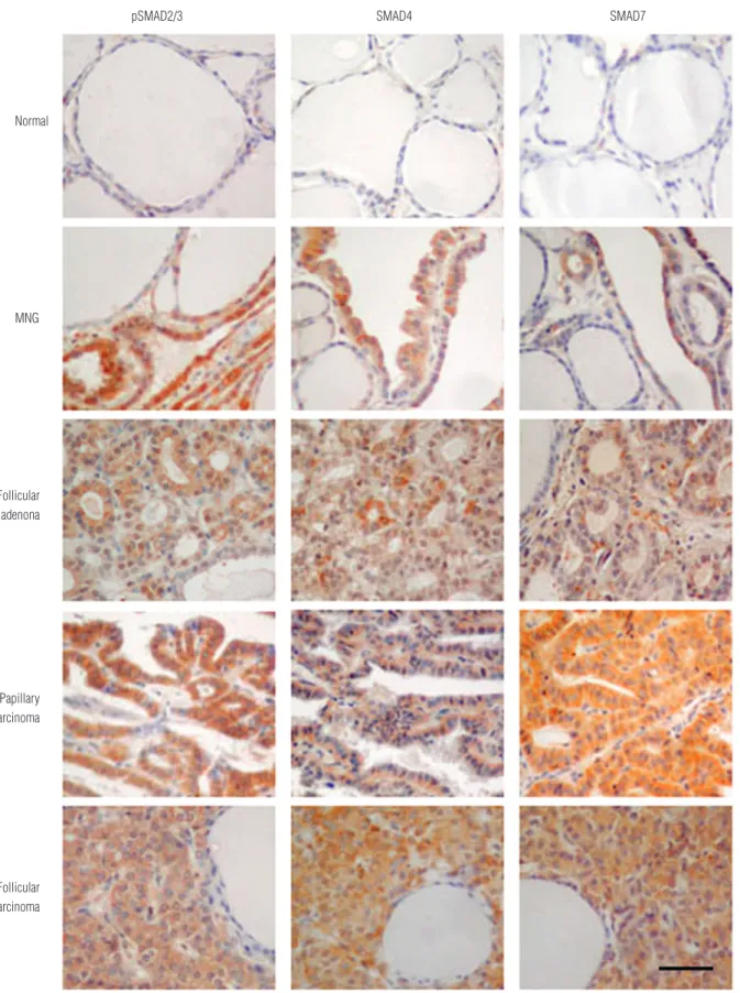 figure  1. Immunohistochemical  staining  for  pSMAD2/3,  SMAD4  and  SMAD7  in  human  thyroid  tumors  by  the  peroxidase  method