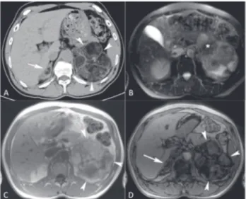 figure 1. Axial CT image (a), axial MR T2-weighted image (b), and in- in-phase  (c)  and  out-of-in-phase  (D)  T1-weighted  images  show  a  large  heterogeneous left adrenal soft tissue mass (arrowheads; a, b and c) with  substantial amount of interweavi