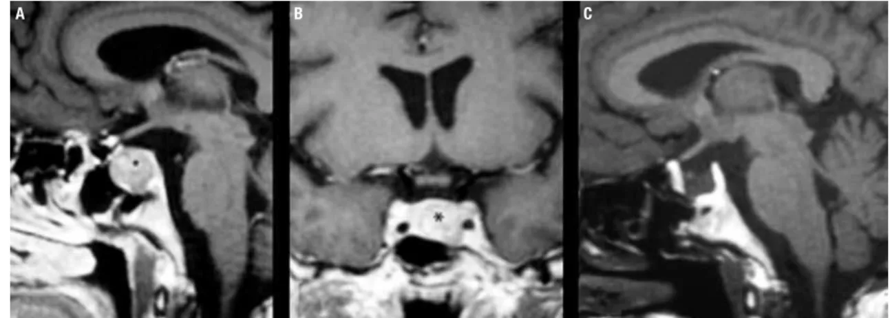 Figure 1. Case 10: (A) Sagittal and coronal (B) contrast-enhanced MR images obtained in an adolescent with Cushing’s disease, demonstrating a macroadenoma  (asterisk); (C) contrast-enhanced sagittal MR imaging scan of the sella four years after transspheno